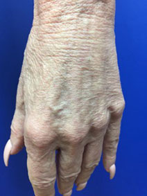 Naples Florida Vanish Vein and Laser Hand Vein Removal Before and After Image