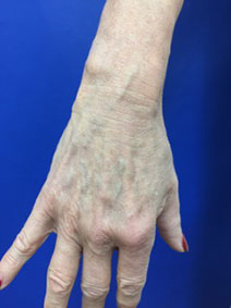 Naples Florida Vanish Vein and Laser Hand Vein Removal Before and After Image