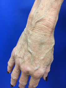 Naples Florida Hand Varicose Vein Treatment by Vanish Vein and Laser Center