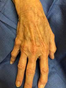 Varicose Hand Vein Treatment by Vanish Vein and Laser Center in Naples Florida