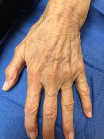 Varicose Hand Vein Treatment by Vanish Vein and Laser Center in Naples Florida