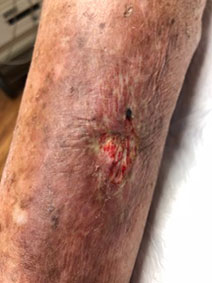 Naples Florida Vanish Vein and Laser Center Treats Venous Leg Ulcers
