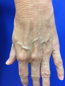 Naples Florida Varicose Vein Hand Treatment Vanish Vein and Laser Center 239-403-0800