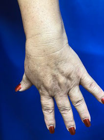Dr John Landi Naples Florida Vanish Vein and Laser Center treats hand veins