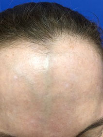 Vanish Vein and Laser Center Treats Face and Head Varicose Veins