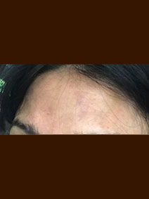 Dr Landi Naples Florida Vanish Vein and Laser Center Treat Face Varicose Veins