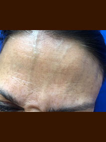 Dr Landi Naples Florida Vanish Vein and Laser Center Treat Face Varicose Veins