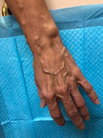 Vanish Vein and Laser Center Naples Florida treats hand varicose veins