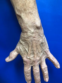 Vanish Vein and Laser Center Naples Florida treats hand varicose veins